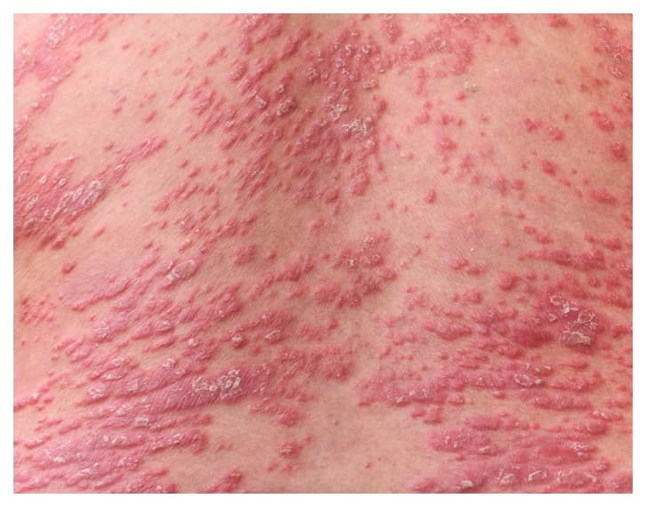 Picture of Psoriasis on Skin