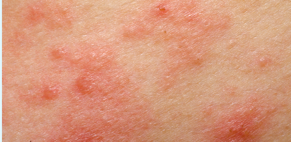 Psoriasis or Eczema | psoriasisSPEAKS