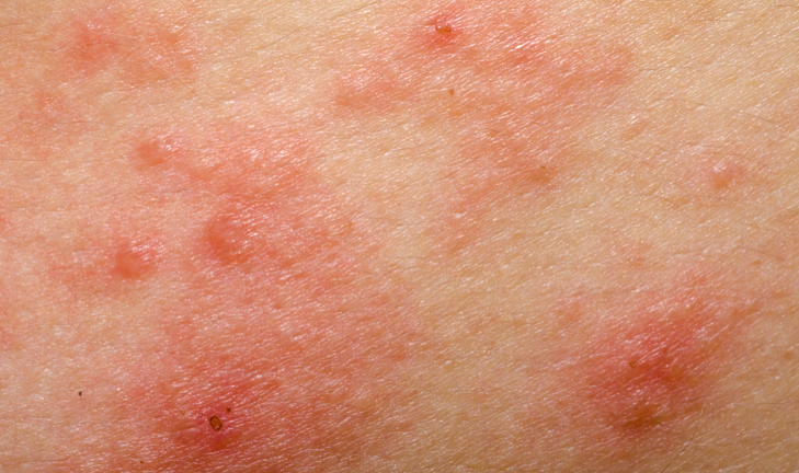 What Is Psoriasis? | psoriasisSPEAKS