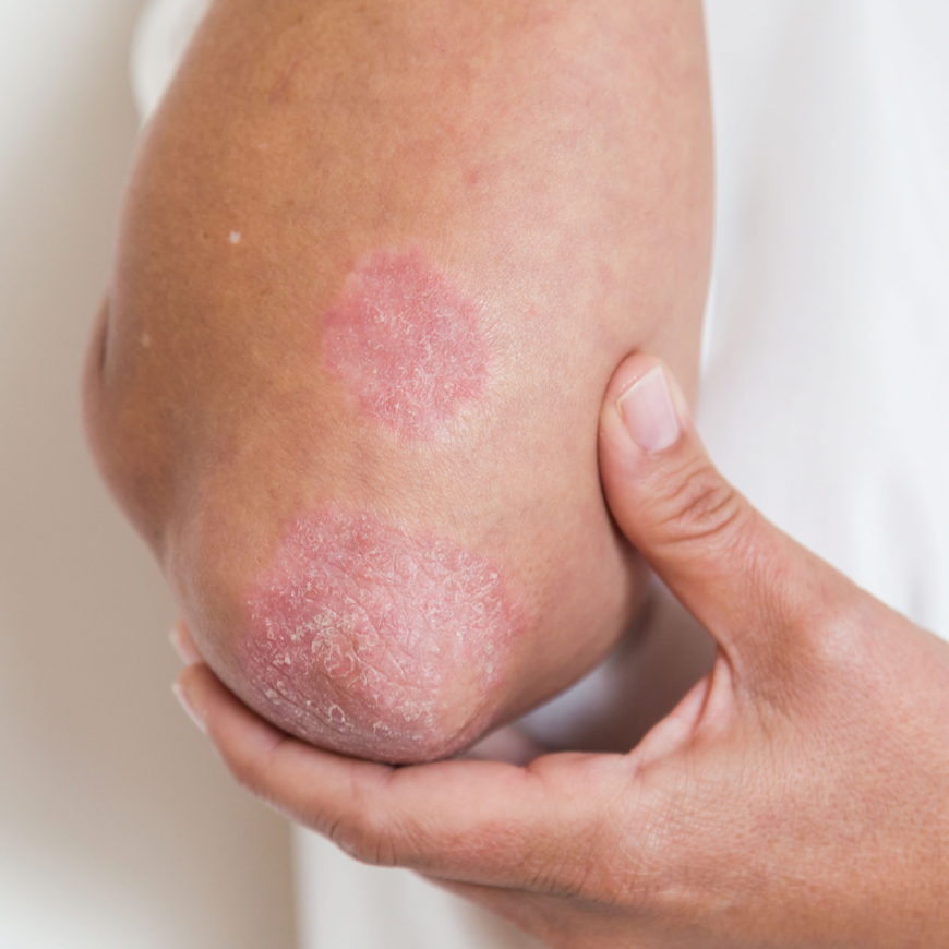 What Is Psoriasis PsoriasisSPEAKS